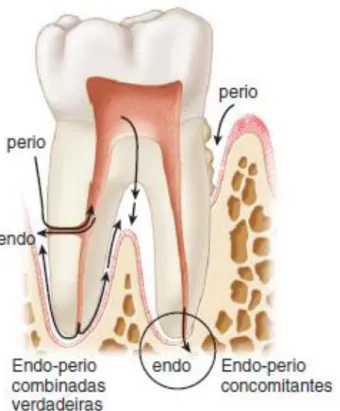 Figura  3.  Lesões  Endodônticas  e  Periodontais  Combinadas  Verdadeiras  e 