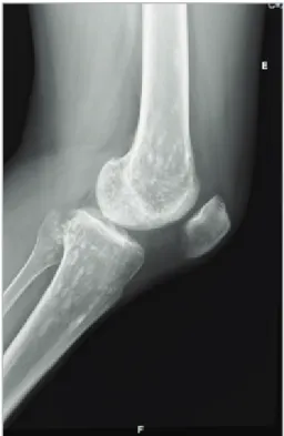 FIGUrE 5. Left knee AP radiography (case 6)