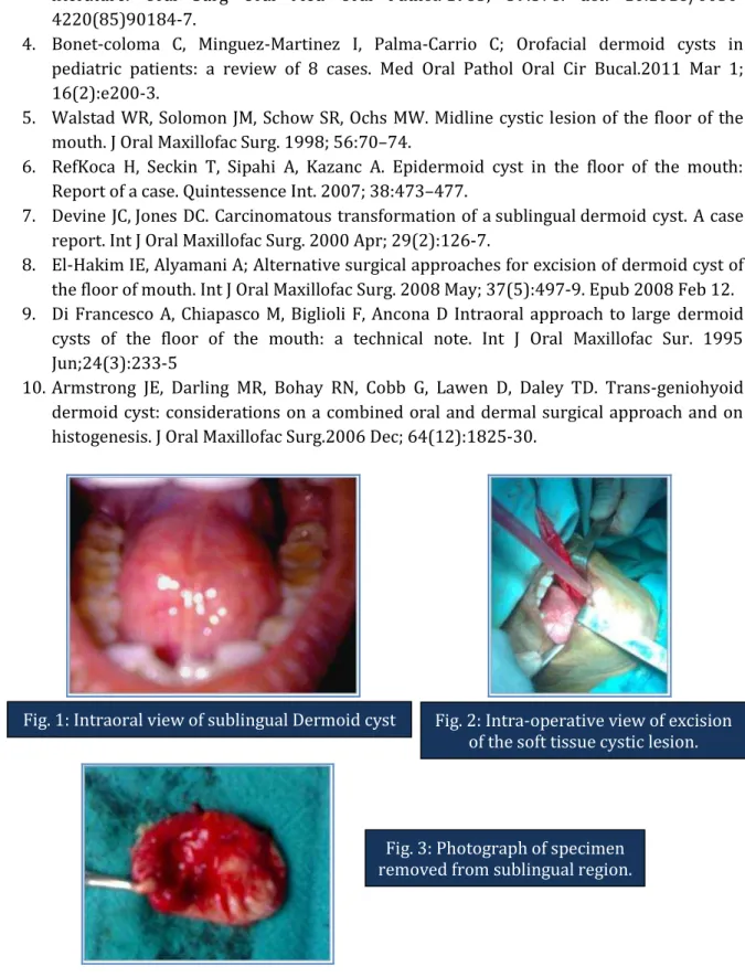 Fig. 1: Intraoral view of sublingual Dermoid cyst Fig. 2: Intra-operative view of excision   of the soft tissue cystic lesion.