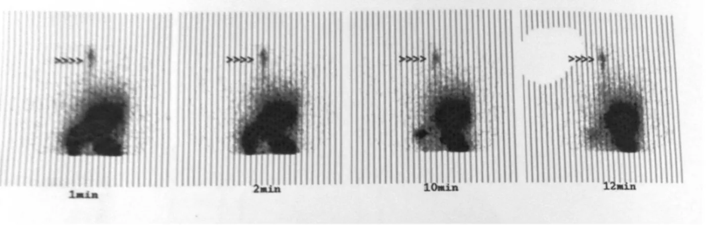 Figure 4. Pulmonary scinitigraphic imaging of the index case (Pointer shows reflux of the tracer to the pharynx from the stomach)