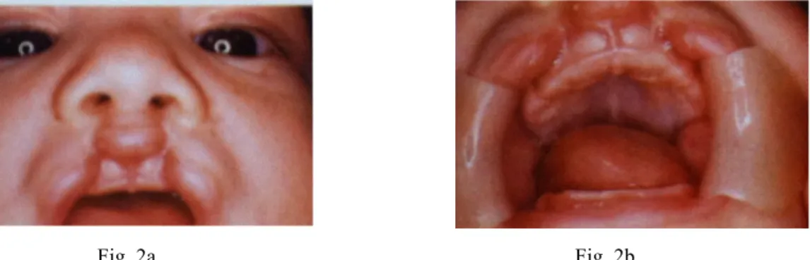 Figura  2a  e  2b:  Fenda  labial  bilateral  incompleta  (fotografia  extra-oral  e  intra-oral)
