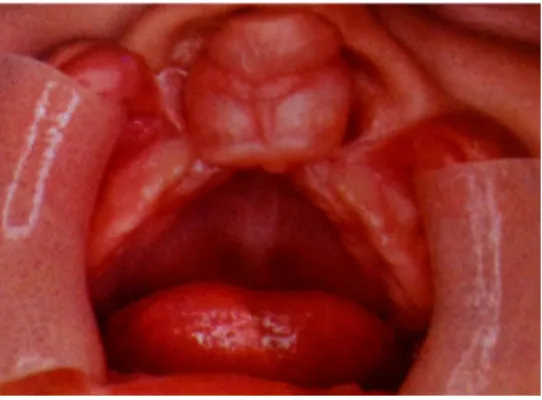 Figura 3a e 3b: Fenda labial e alveolar unilateral completa (fotografia extra-oral e intra- intra-oral)
