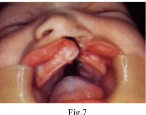 Figura 7: Fenda labial e palatina completa unilateral. Retirada de Machado et al., 2005 