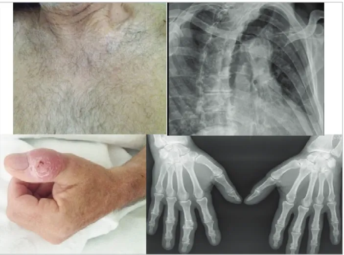 FIGURe 1. Swelling of the 1st left interphalangeal and left sternoclavicular joint and respective radiographs.