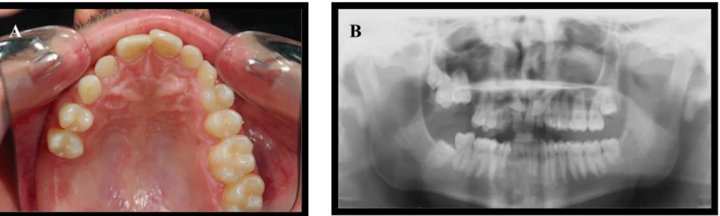 Figura 1. Paciente do sexo masculino com 24 anos de idade, com os dentes 1.6, 1.7 e 1.8 anquilosados