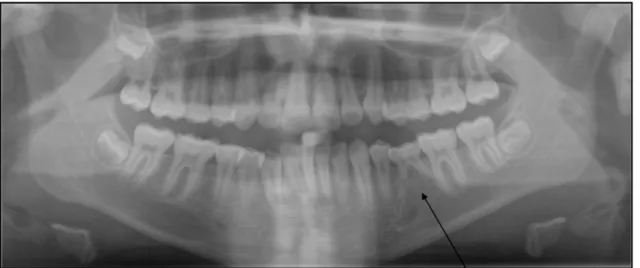 Figura 3. Anquilose tardia e reabsorção radicular do dente 7.5 (Adaptado de Lopes 2013)