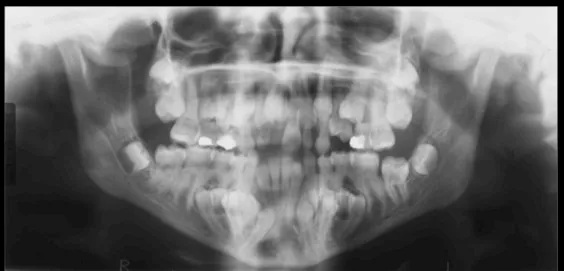 Figura 4. Ortopantomografia de uma paciente, 14 anos de idade, com disostose cleidocraniana