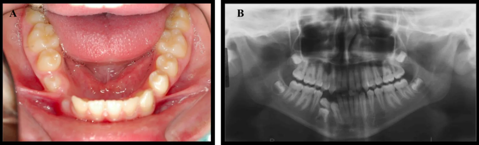 Figura 5. Fotografia intra-oral da arcada mandibular (A) e Ortopantomografia antes do tratamento (B)  (Caso clínico e imagens cedidas pelo Professor Doutor Jorge Dias Lopes).