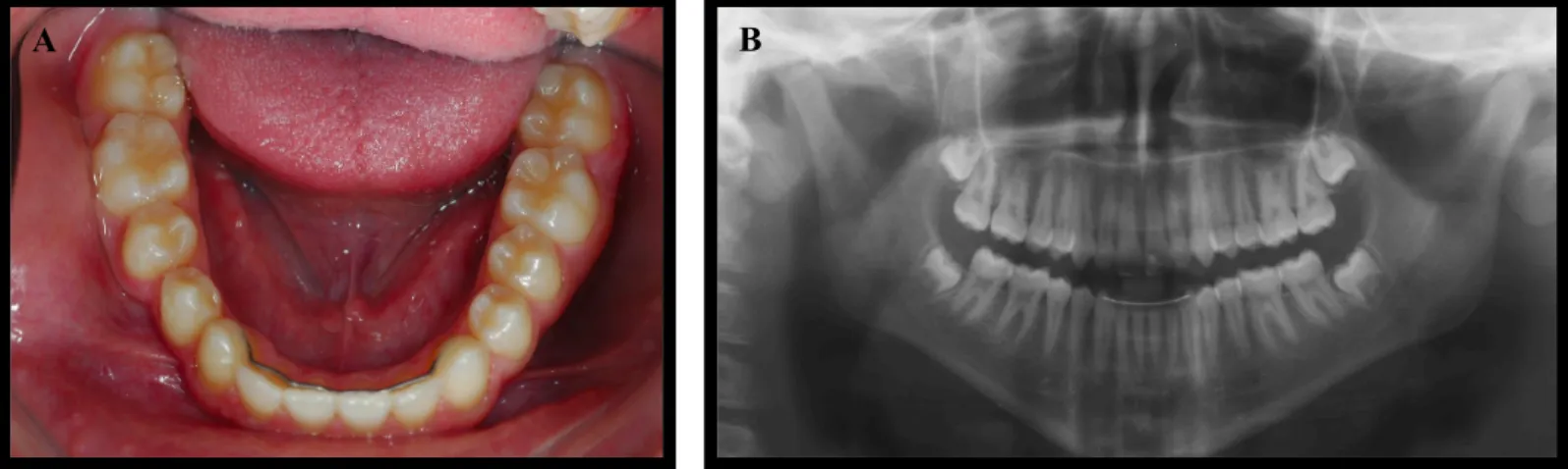Figura 6. Fotografia intra-oral da arcada mandibular (A); Ortopantomografia pós-tratamento (B)  