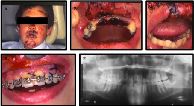 Figura 8. Fotografias extra-oral (A) e intra-oral (B,C) 48 horas após traumatismo com avulsão dos dentes  1.1, 2.1 e 2.2