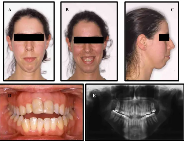 Figura 10. Fotografias extra-orais (A,B e C), intra-oral (D) e Ortopantomografia (E), pré-tratamento (caso  clínico e imagens cedidas pelo Professor Doutor Jorge Dias Lopes)