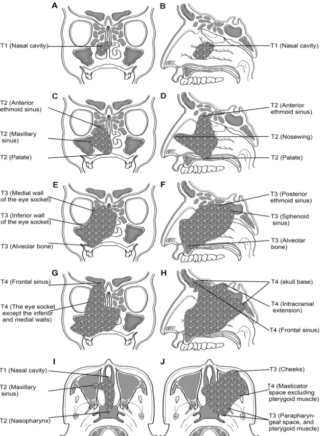 Fig 1. Veiws of definition of T classifications for tumor originating from the nasal cavity