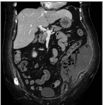 FIGURE 1. Abdominal computed tomography scan showing giant abdominal abscess in left iliac fossa