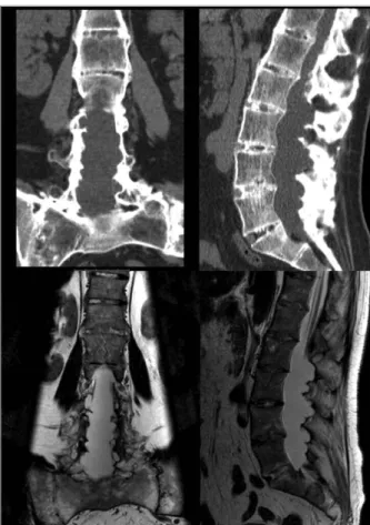 FIGURA 1. Achados imagiológicos na tomografia axial computorizada lombar (em cima) e na ressonância magnética lombar (em baixo)