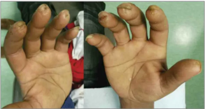 FIGURE 1. Patient’s hands showing digital ulcers