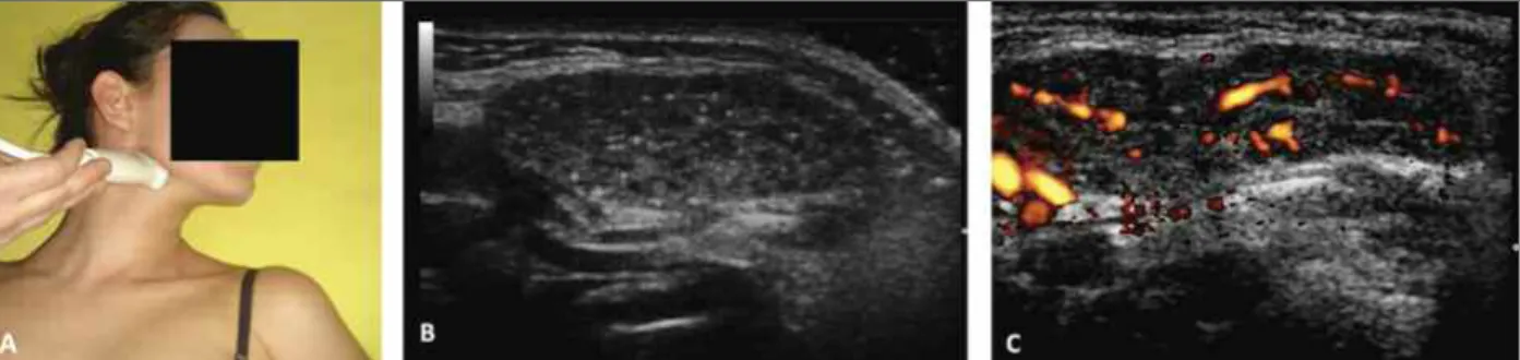 FIGurE 1. Female, 7-year-old, exhibiting salivar glands ultrasound with Grade 4 by the B-mode method, intense power Doppler  signal and decreased vessels internal resistance, supporting the diagnosis of juvenile Sjögren's syndrome.