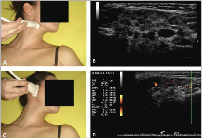 FIGurE 2. Salivary glands Ultrasound and Spectral Doppler of a female, 10-year-old patient, consistent with chronic and active  inflammatory process of the salivary glands in the juvenile Sjögren's syndrome