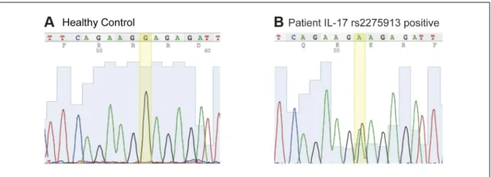 FIGUrE 2. Difference in gene sequence. A. Healthy control B. Patient who tested positive for IL-17 rs2275913