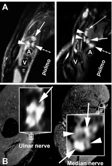 Fig 3. High-resolution magnetic resonance neurography in meningoencephaloradiculitis. HrMRN in plexus localisation (A): Pathological signal hyperintensities in high-resolution, T2-weighted coronal images of the brachial plexus
