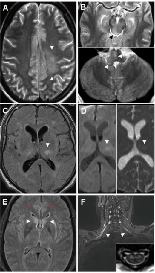 Fig 2. Neuroimaging findings in severe TBE. (A and B), A 23-year-old male patient with severe ME and extensive panencephalitis but complete recovery after 12 months