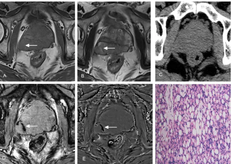 Figure 1. A 64-year-old man with prostate cancer in peripheral zone of the prostate. Heterogeneous signal on conventional T1WI (A) and T2WI (B) (arrows) indicates tumor hemorrhage