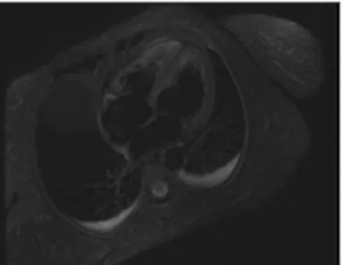 FIGURE 1. Imagem RM - edema do miocárdio nos segmentos basal e médio do septo interventricular