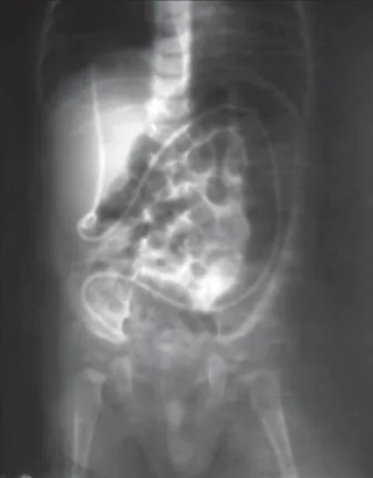 Figure 3. X-ray of the abdomen and pelvis with shadow of VP catheter  in the urinary bladder
