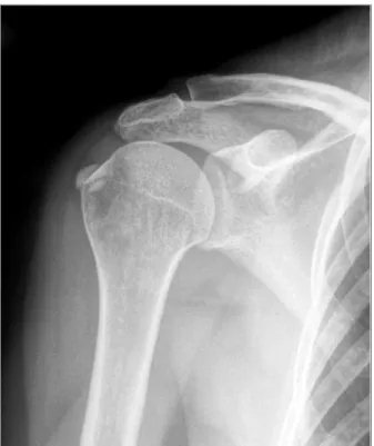 FIGurA 1. Radiografia AP do ombro direito – corpos cálcicos justa-troquiterianos compatíveis com fenómeno de