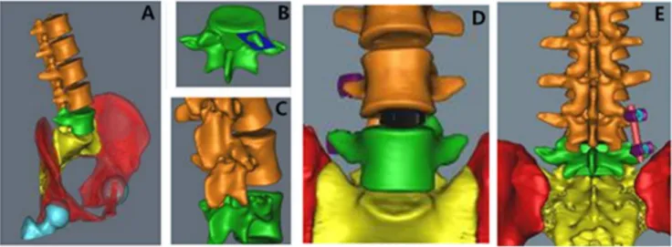 Figure 2. Mimics simulation of extraforaminal lumbar interbody fusion. (A) Three-dimensional reconstruction of the spinal column; (B) extraction of the L 5 vertebral body and resection of the superior articular process; (C) exposure of the intervertebral s