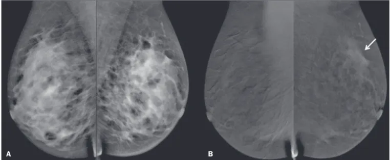 Figure 2. Residual (2.2-cm) tumor in a 23-year-old woman. FFDM (A) was negative, whereas CESM (B) overestimated the tumor size.