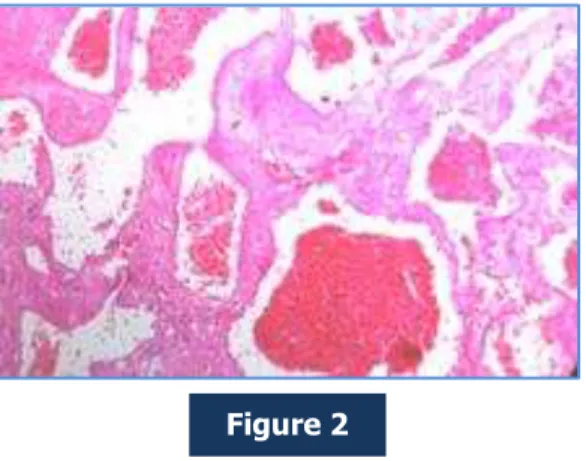 Figure 3: H &amp; E stained section showing sinusoidal spaces filled with organized thrombi 400x