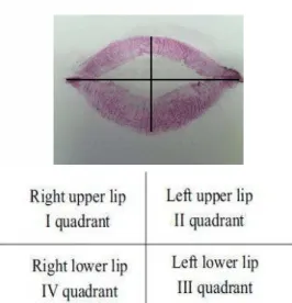 Fig. 1:  Division of  lip int o four quadrant s.