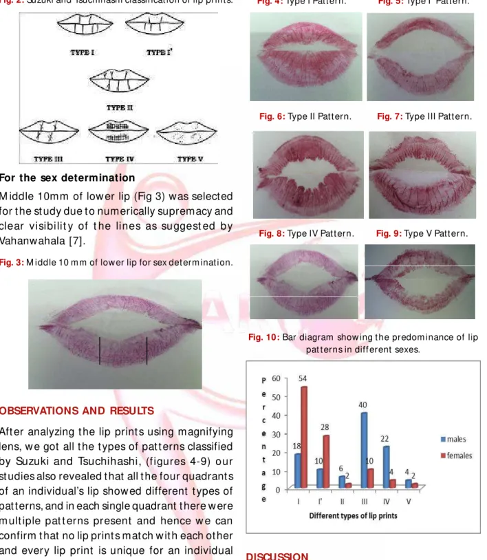 Fig. 2:  Suzuki and Tsuchihashi classif icat ion of  lip print s.