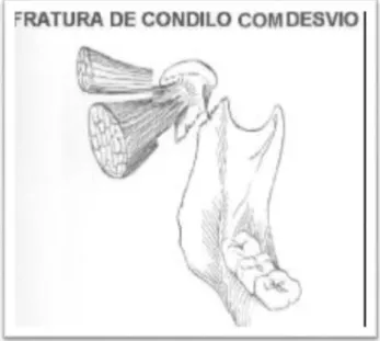Figura 10 - Fratura de côndilo com desvio. 