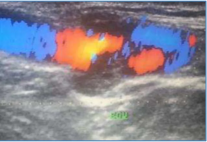 Fig. 1: Colour Doppler Image of left EJV in Sagittal  Section showing Peripheral Eccentric Colour Filling 