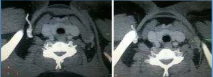Fig.  3:  Axial  CT  Sections  showing  dilated  EJV  with  Non-enhancing Lumen and Peripheral Enhancement 