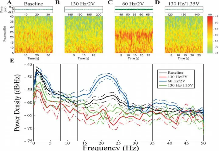 Fig 1. Example STN during the different stimulation sets. A, B, C, and D are raw waveforms and spectrograms from the baseline epoch, 130 Hz/2V DBS epoch, 60 Hz/2V DBS epoch, and 130 Hz/1.35V DBS epoch, respectively