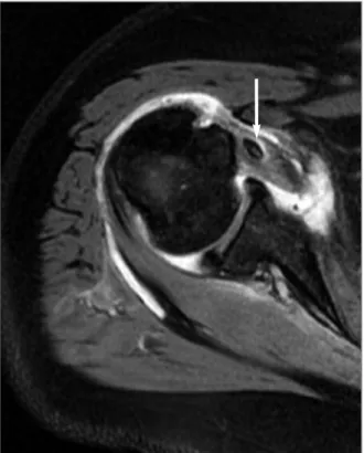 FIGure 5. SLAP lesion with a well-defined plane between the supraglenoid tubercle and the LHB tendon origin
