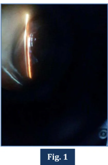 FIG. 2: Showing thinning and peripheral stromal opacification of superior cornea. 