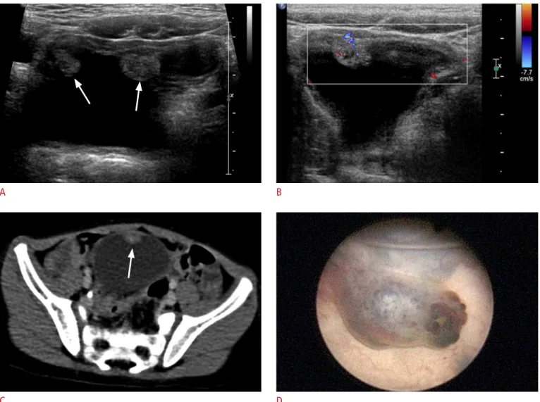 Fig. 1. A 4-year-old boy with recurrent gross hematuria due to multiple bladder hemangiomas.