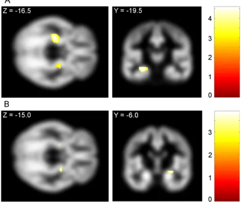 Figure 3. Alcohol Use Disorders Identification Test scores are negatively correlated with hippocampus and amygdala grey matter volume
