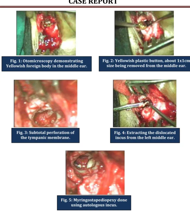 Fig. 1: Otomicroscopy demonstrating   Yellowish foreign body in the middle ear.