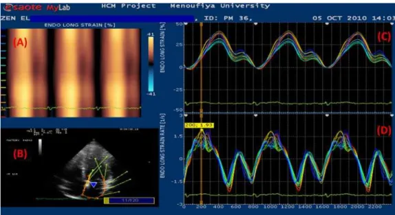 Figure 1. LA strain and strain rate using VVI. A: Curved M-mode of LA longitudinal strain