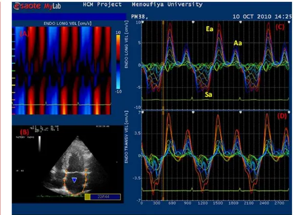 Figure 2. Assessment of LA wall velocity using VVI. A: Curved M-mode of LA longitudinal velocity