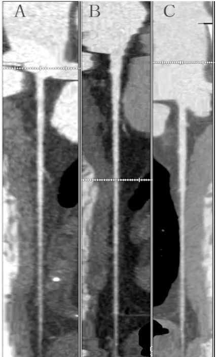 Fig 3. CTA of left anterior descending coronary artery in three patients using three protocols