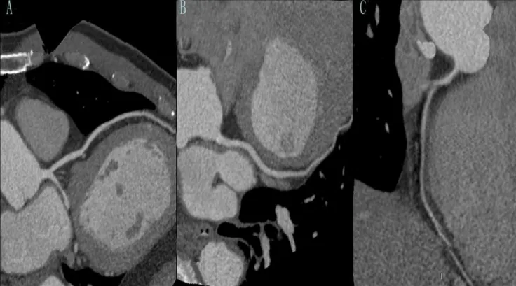Fig 4. One example. A 54-year-old man with a history of chest pain underwent CT coronary angiography (curved MPR with 100kVp, protocol) and BMI of 26.4 kg/m 2 