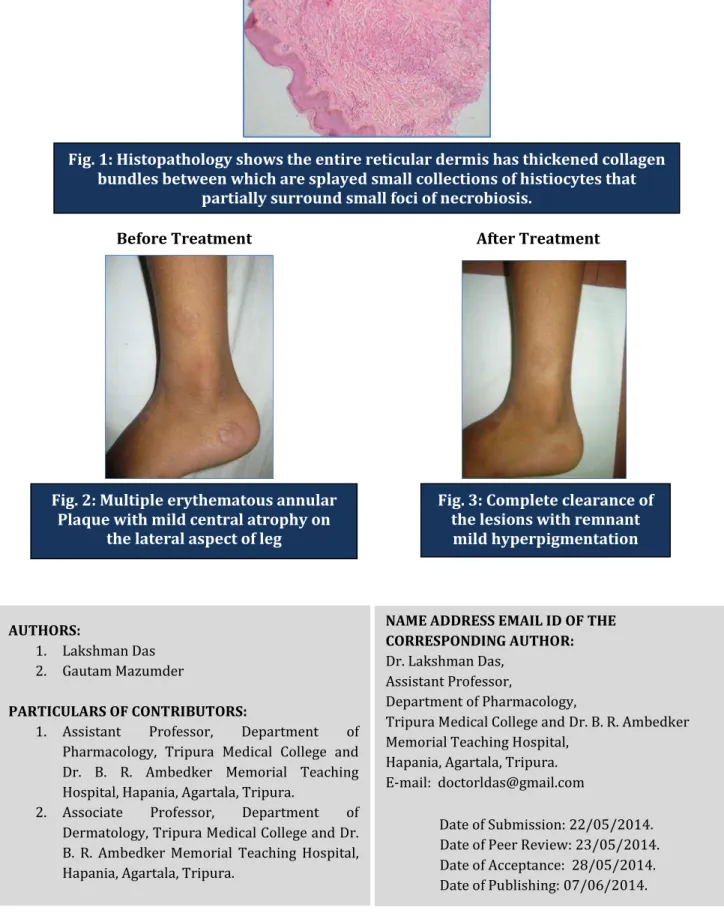 Fig. 2: Multiple erythematous annular  Plaque with mild central atrophy on  