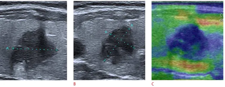 Fig. 8. Example of a nodule classiied as TI-RADS 5. 