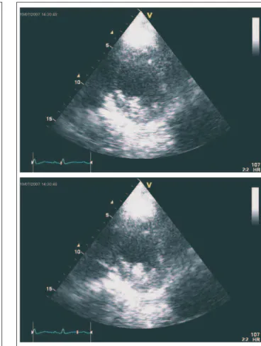 Abbildung 4: Apikaler 4-Kammerblick postoperativ, oben Enddiastole, unten End- End-systole; Rückbildung der Kompression der basalen und mittleren Lateralwand in der Enddiastole (Pfeil).