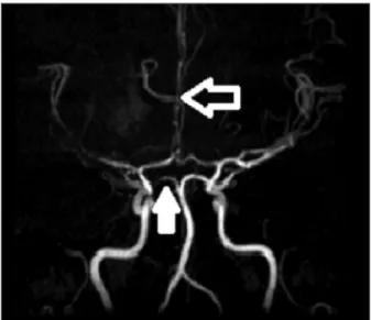 fIGure 3. Beaded appearance of both ACAs(black arrow) and left PCA